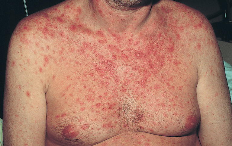 uker etter, aktuelle kortikosteroider, alvorlige tilfeller, noen ganger, Seborrheic dermatitt