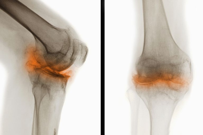 Arthritis Foundation, lindre smerte, påvirker omtrent, redusere betennelse