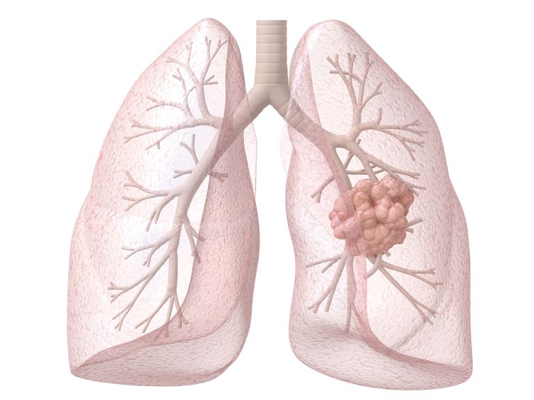 lungekreft tidligere, Symptomer lungekreft, diagnostisert lungekreft, årsaken lungekreft
