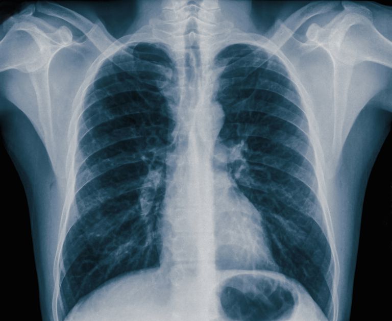 berørte siden, lungene brystveggen, mellom lungene, mellom lungene brystveggen, noen tilfeller, rommet mellom
