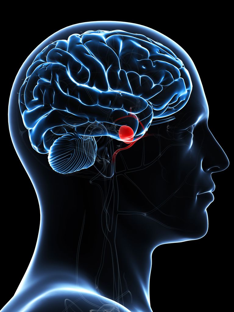 Brain aneurysm, nevrologiske symptomer, aneurysm kirurgi, Brain aneurysm kirurgi, Brain Brain, fleste hjerneaneurysmer