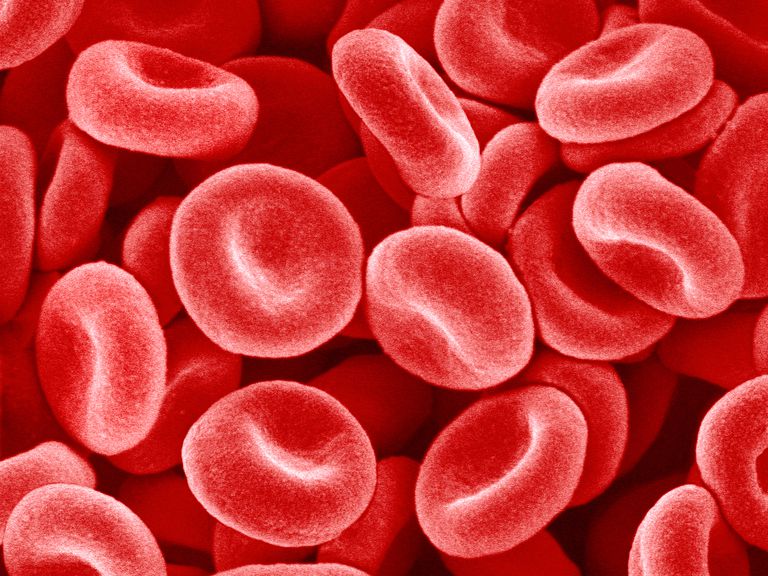 hemolytisk anemi, røde blodlegemer, også kalt, eller matvarer, hemolytisk krise