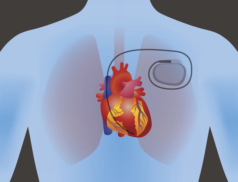 grad blokk, elektriske impulser, blokk betyr, hjertets elektriske, Hvis hjerteblokk, nesten alltid