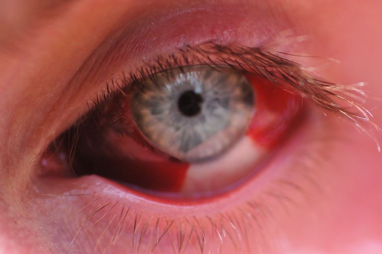delen øyet, subkonjunktiv blødning, blod øyet, hvite delen, hvite delen øyet, rødt blod
